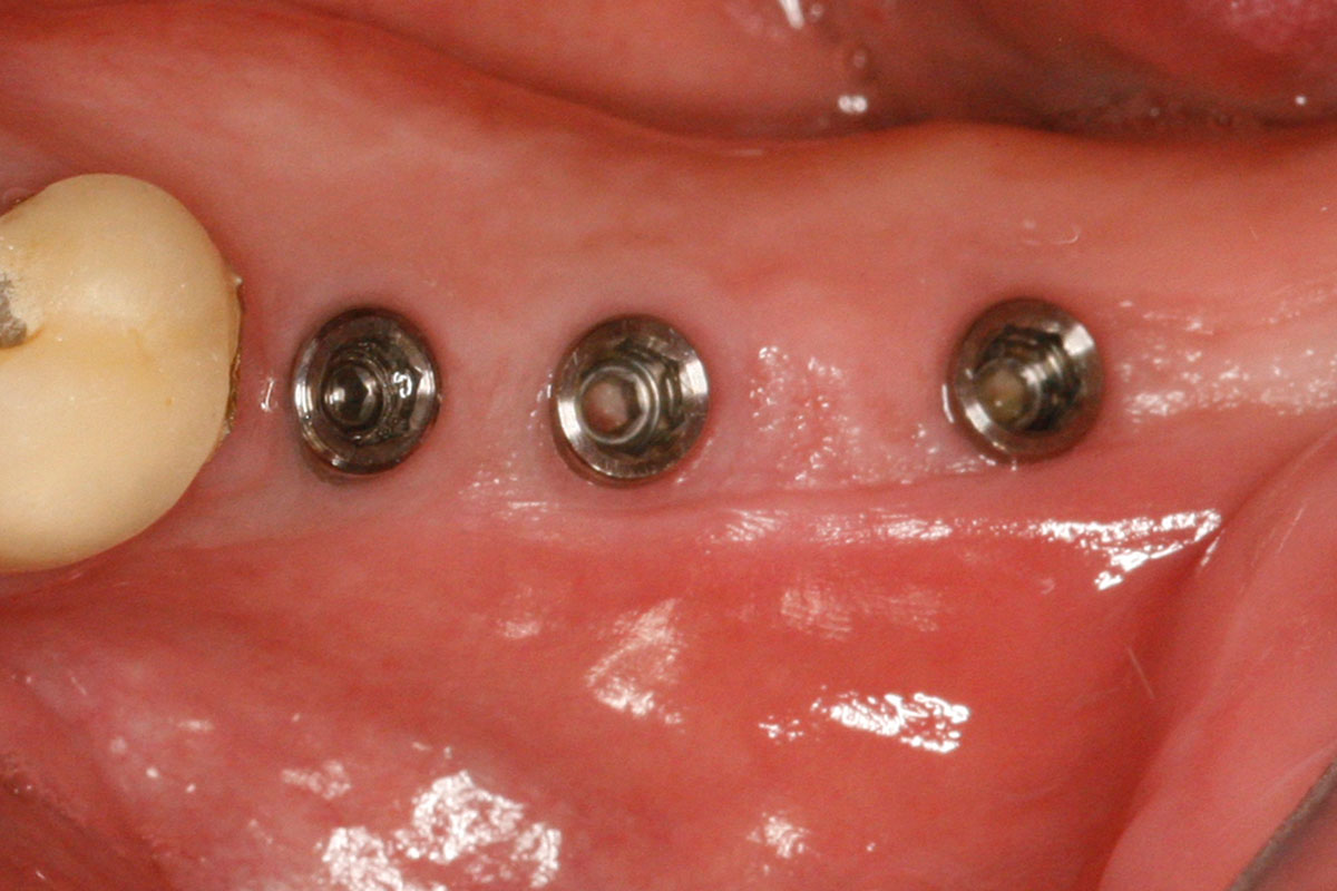 Nach der Implantation. Die Implantate wurden durch das Zahnfleisch eingebracht, ohne den Knochen dabei freuzulegen.