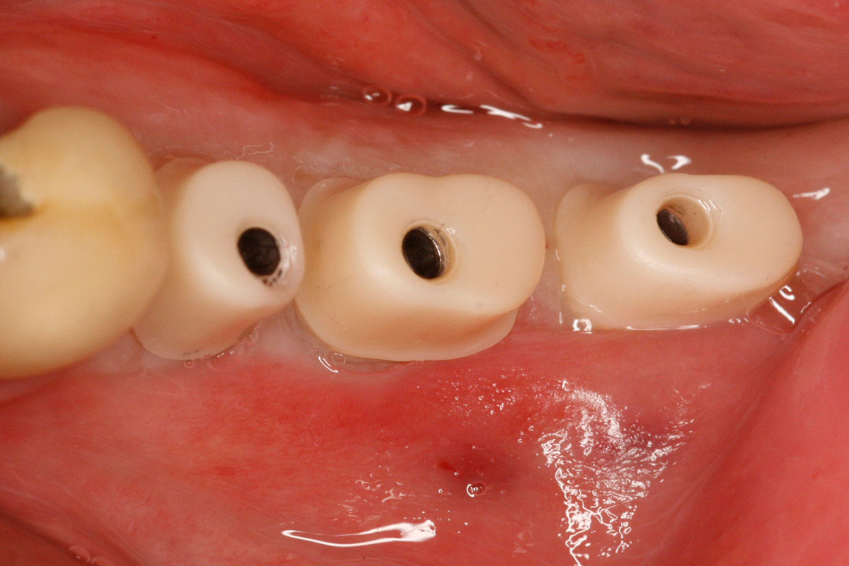Nach 8 Wochen Einheilzeit sind künstliche Zahnstümpfe auf die Implantate geschraubt.