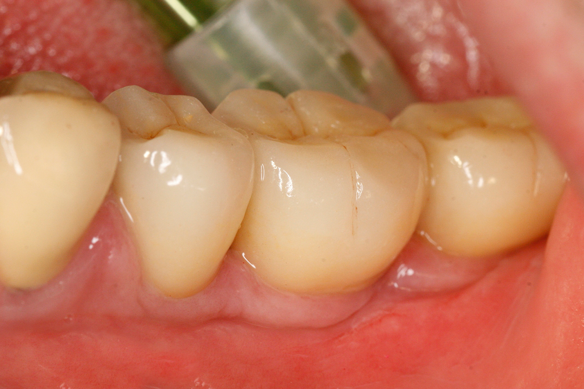 Situation des Zahnfleisches an den künstlichen Kronen nach über 2 Jahren.